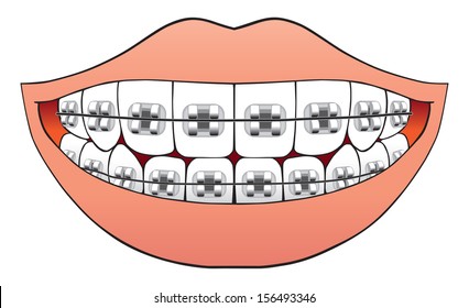 Teeth with braces