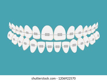 Teeth with braces. Alignment of bite of teeth, dental row with with braces, Dental braces. Vector illustration.