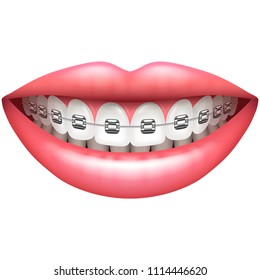 Dental Photo Brace Stock Vectors Images Vector Art Shutterstock