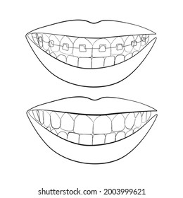 Teeth with braces, female smile line art on white isolated background