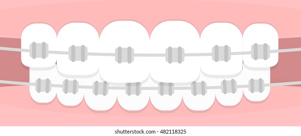 Teeth braces. Flat illustration