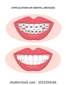 Teeth with braces on white background. Vector illustration.