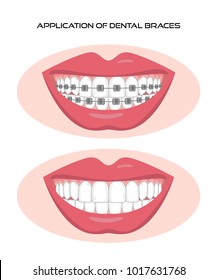 Teeth with braces on white background. Vector illustration.