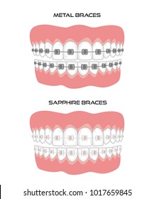 Teeth with braces on white background. Vector illustration.