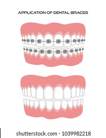 Teeth with braces on white background. Vector illustration.