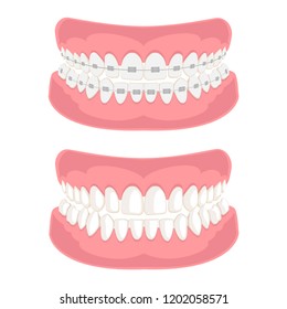 Teeth with braces on white background. Dental jaw with braces, Dental braces. Vector illustration.