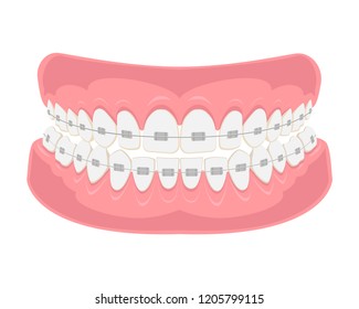 Teeth with braces on white background. Alignment of bite of teeth, correct bite of teeth. Dental jaw with braces, Dental braces. Vector illustration.