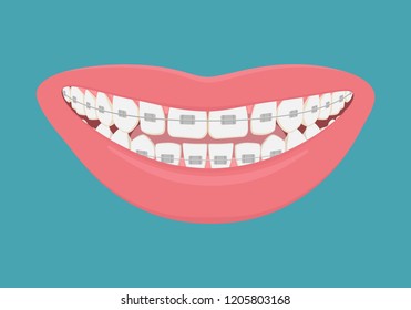 Teeth with braces on white background. Alignment of bite of teeth, correct bite of teeth. Dental jaw with braces, Dental braces. Vector illustration.