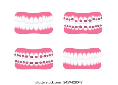 Teeth with braces. Orthodontic treatment. Tooth braces. Teeth with metal brackets