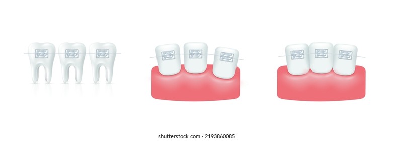 Teeth with braces set Orthodontic dentistry. Alignment of tooth elements. Healthy lifestyle and dental care. Beautiful white teeth with brackets isolated realistic. Vector illustration