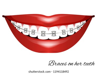 Teeth with braces. Smile. Vector illustration.