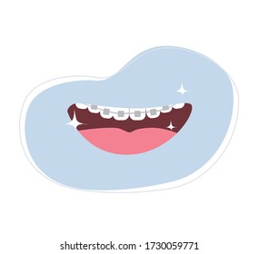 Teeth with braces. Smiling mouth with tongue and healthy teeth. Smile. Dentistry concept. Cute vector illustration in flat style.