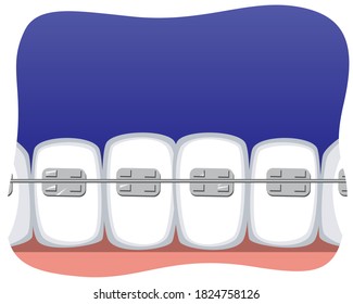 Teeth with braces and space for text or copy space on a blue background. Flat vector stock illustration with molars and incisors as a concept of orthodontic services, braces, bite alignment