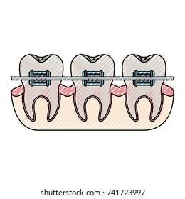 teeth with braces and tooth root view in colored crayon silhouette