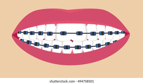 Teeth braces. Vector illustration
