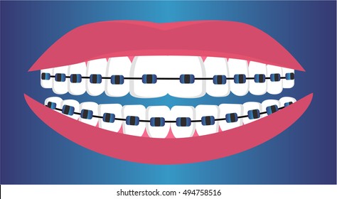 Teeth braces. Vector illustration