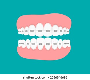 Teeth with braces.Flat vector illustration. Jaws isolated. orthodontic treatment braces on teeth. Dentistry and Orthodontics treatment. Dental Row with with Braces