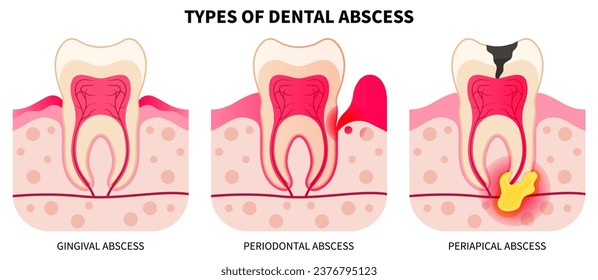 Teeth broken and wisdom cavities cracked swollen in the oral cavity pain bad breath hygiene health