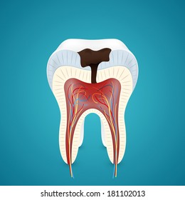 Teeth caries in cutaway Isolated on blue background
