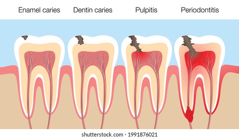 Teeth with caries stages, development of tooth decay with enamel and dentin caries, pulpitis and periodontitis. Vector illustration on white background.
