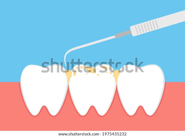 Teeth cartoon vector. dental equipment vector.\
Tartar buildup are common\
dental.