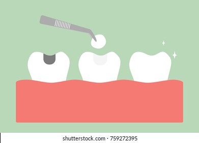 teeth cartoon vector flat style for design - tooth amalgam filling with dental tools