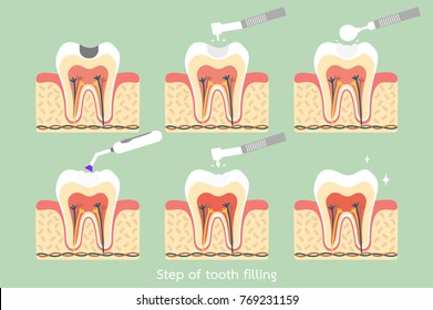 teeth cartoon vector flat style for design - step of caries to tooth amalgam filling with dental tools, anatomy structure including the bone and gum