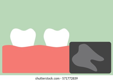 teeth cartoon vector, x-ray wisdom tooth