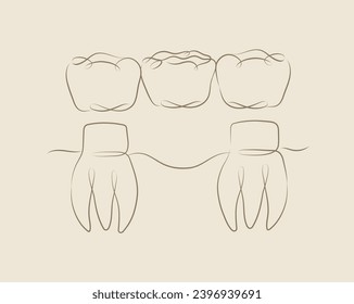 Dientes con ilustración del puente de la corona dibujando en un estilo lineal sobre fondo beige