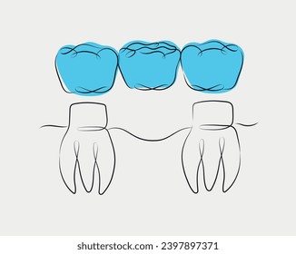 Teeth with crown bridge illustration drawing in linear style on white and blue background