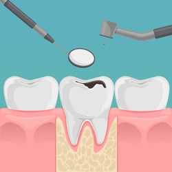 Teeth With Decay In Gum. Tooth With Caries Hole Treatment Concept. Dentist's Tools. Flat Cartoon Dentistry Vector Illustration.