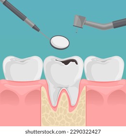Teeth with decay in gum. Tooth with caries hole treatment concept. Dentist's tools. Flat cartoon dentistry vector illustration.