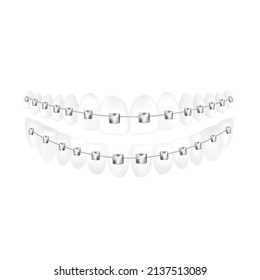 Teeth with dental braces for alignment of the bite of teeth, realistic vector illustration isolated on white background. Dental medical braces template.