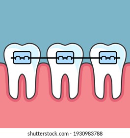 Teeth with dental braces, dental arrange, vector