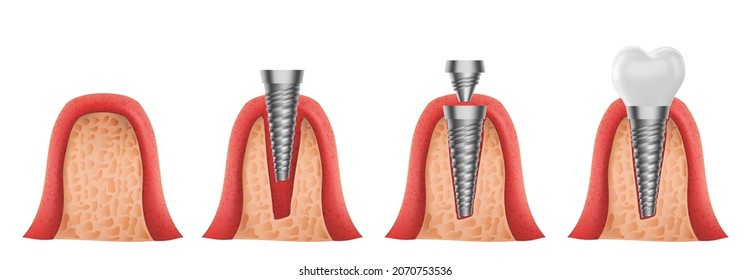 Teeth and dental implant realistic vector design of dentistr