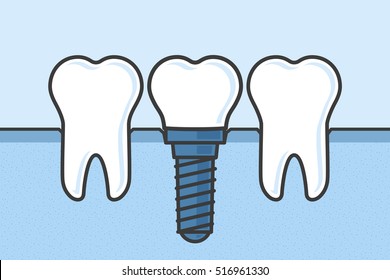 Teeth with dental implant vector illustration.