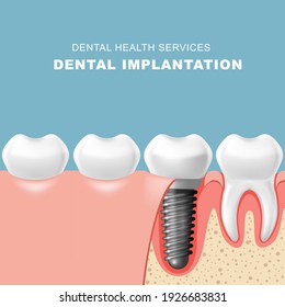 Teeth and dental implantat inserted into gum - tooth implantation