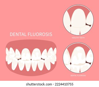 Teeth discolored in Dental with Fluorosis pitted of grooved Turner's hypoplasia