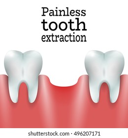 Teeth Family with Extracted Tooth in Healthy Gum.Dental Pain free Tooth Extraction Surgery Dentistry Vector Illustration.Medical Conception Tutorial for Tooth Clinic.Oral Surgery for Dental Clinic