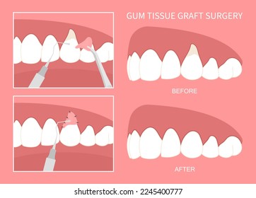 Teeth grafting procedure for recession gummy smile buildup swelling Loose black Toothache cavity root decay canal abscess oral pain thin injury cosmetic recontouring crown prep dentistry