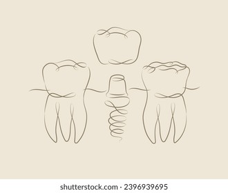 Dibujo de implantes de dientes en un estilo lineal sobre fondo beige