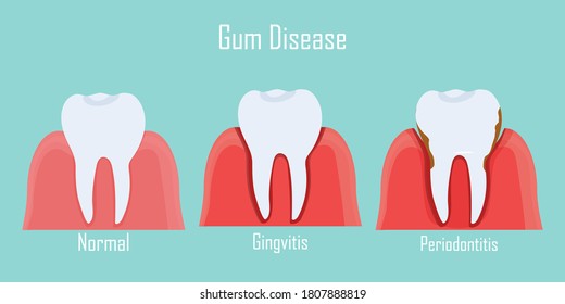 Teeth infographic Gum disease stages gingivitis and periodontitis. Editable vector illustration in flat style. Medical concept in natural colors on background. Keep your teeth healthy