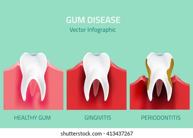 Teeth infographic. Gum disease stages. Editable vector illustration in modern style. Medical concept in natural colors on a light green background. Keep your teeth healthy