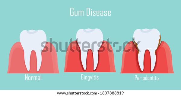 Teeth infographic Gum disease stages gingivitis\
and periodontitis. Editable vector illustration in flat style.\
Medical concept in natural colors on background. Keep your teeth\
healthy