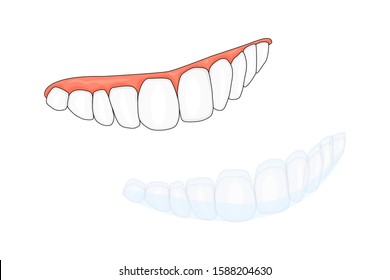 Teeth and invisalign braces or invisible retainer isolated on white background. A way to have a beautiful smile. Dental, orthodontic treatment concept. Dental braces. Orthodontics. Stock vector