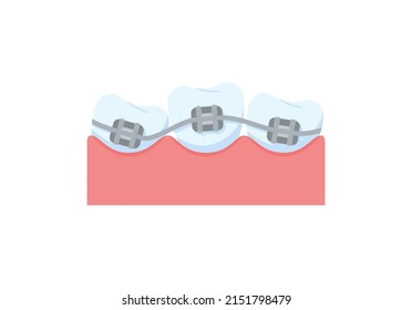 Teeth with metal braces for correction flat style, vector illustration isolated on white background. Teeth alignment, dentition with braces, dental concept