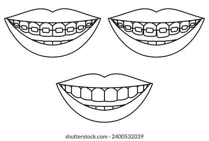 Teeth with metal brackets in cosmetic dentistry and orthodontics, simple line drawing, Vector Illustration