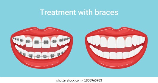 Dientes en la boca con o sin llaves. Durante y después del tratamiento ortodóntico. La alineación de los dientes. Estilo de vida saludable y atención dental. Hasta dientes blancos con una sonrisa. Vector plano aislado