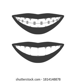 Teeth in the mouth with or without braces. During and after orthodontic treatment. 