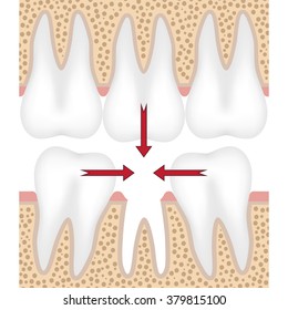 Teeth are moving to fill empty space from missing tooth.